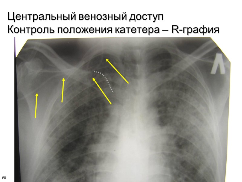 68 Центральный венозный доступ Контроль положения катетера – R-графия